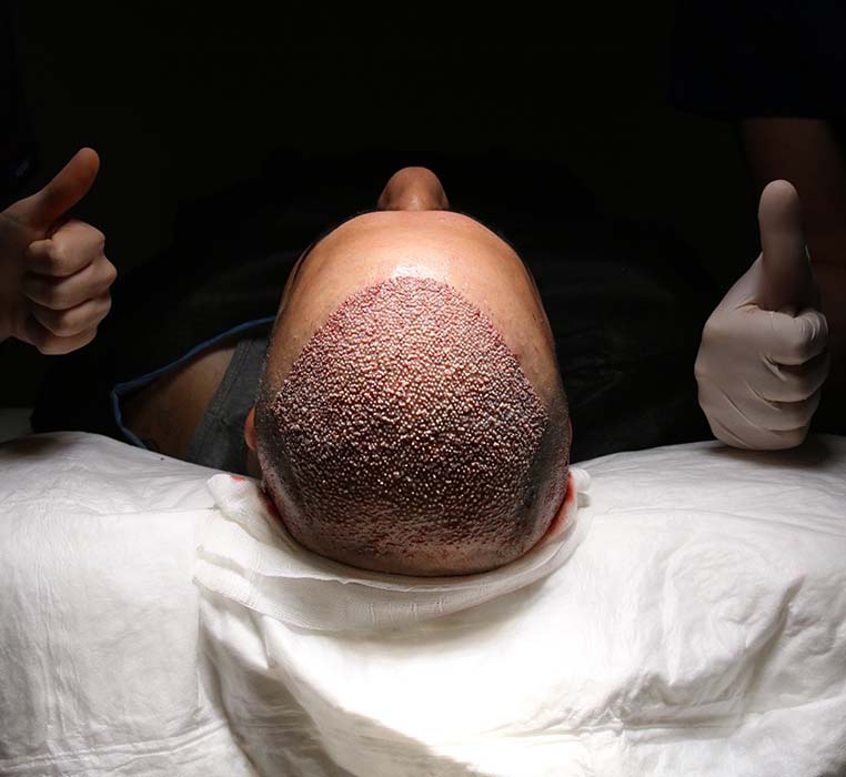 DHI Hair Transplant: The Future of Hair Restoration