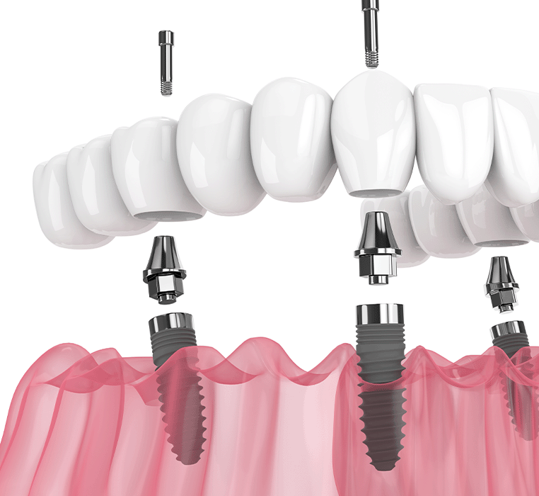 Smile Confidently: Full Mouth Dental Implants in Turkey