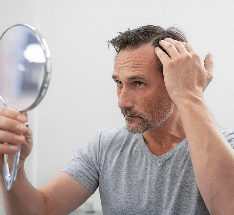 Alopecia Areata: Causes and Treatment Methods