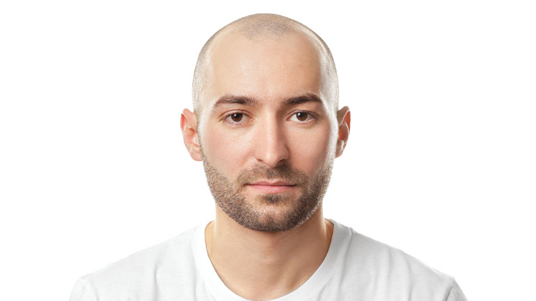 Does Sapphire FUE Offer a Definitive Solution to Baldness?