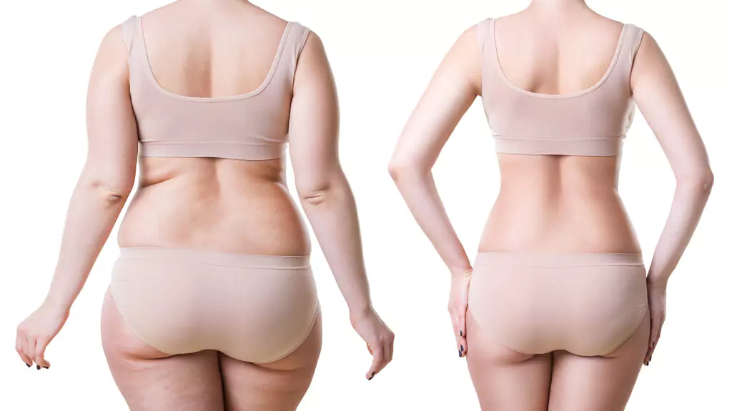 What is Liposuction and How is it Applied?