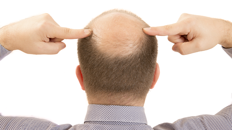 Male Pattern Baldness Genetics
