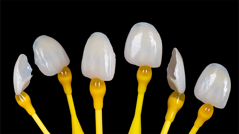 What are the Most Popular Methods for Dental Veneers?