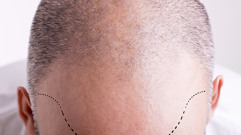 Do More Hair Grafts Mean Healthier Results?