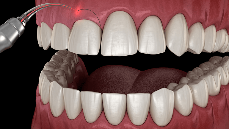 What is Gingivectomy and how is it performed?