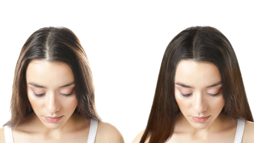Queries About FUE Hair Transplantation